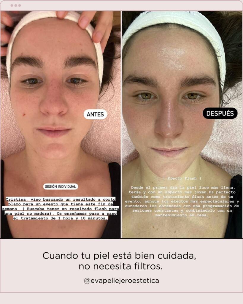 radiofrecuencia-facial-zaragoza 